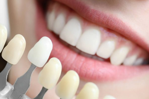 Quanto Tempo Duram as Lentes Odontológicas? Saiba a Durabilidade e Cuidados Necessários