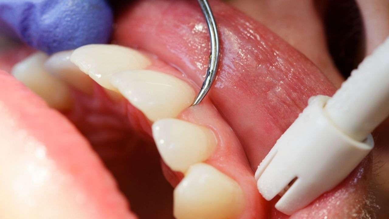 Periodontia: A Guarda-Costas dos Seus Dentes